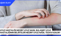 Uyuz Hastalığı Nedir? Uyuz Nasıl Bulaşır? Uyuz Hastalığının Belirtileri Nedir? Uyuz Nasıl Tedavi Edilir?