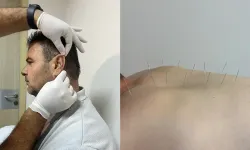 Uşak’ta Akupunktur Tedavi Hizmeti Başladı