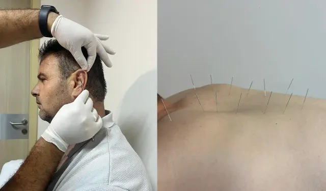 Uşak’ta Akupunktur Tedavi Hizmeti Başladı